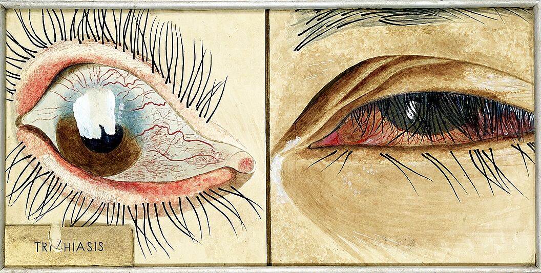 Trichiasis