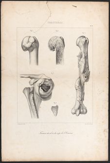 Fractures du col et du corps de l'Humérus